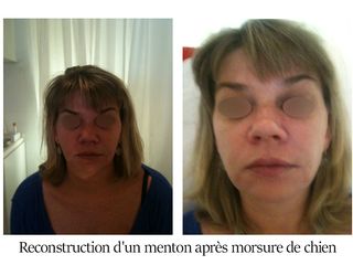 Reconstruction d'un menton après morsure de chien - Dr Brigitte Dautel