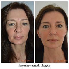 Rajeunissement du visagege - Dr Brigitte Dautel