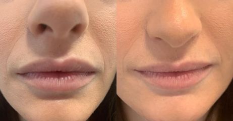 Augmentation des lèvres - Dr Brigitte Dautel