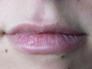 Augmentation des lèvres
