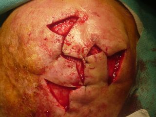 Fermeture et reconstruction par lambeau d'une lésion de la voute cranienne