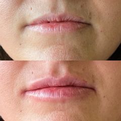 Augmentation des lèvres - Dr Bertrand Joly