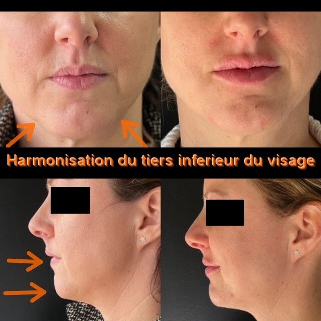 Génioplastie Avant Et Après Multiesthetique Fr Multiesthetique Fr