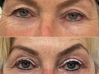 Blépharoplastie médicale avant et après - 878524