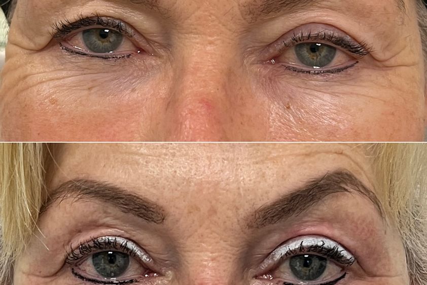 Blépharoplastie médicale avant et après - 878524