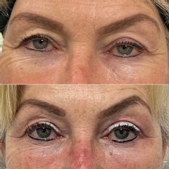 plasma preop - plasmapost