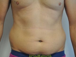 Avant cryolipolyse chez homme de 43 ans
