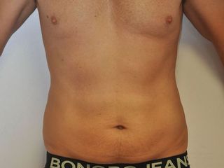 Après cryolipolyse chez homme de 43 ans