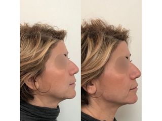 Injection radiesse ovale du visage-jawline contouring - Doctor and Co PARIS