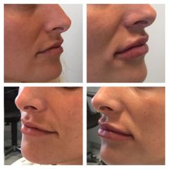 Augmentation des lèvres - Dr Alexandre Krassoulia