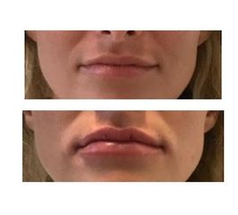 Augmentation des lèvres - Dr Alexandre Krassoulia