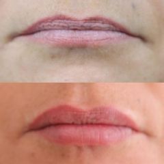 Injection d’acide hyaluronique dans les lèvres - Centre Essential