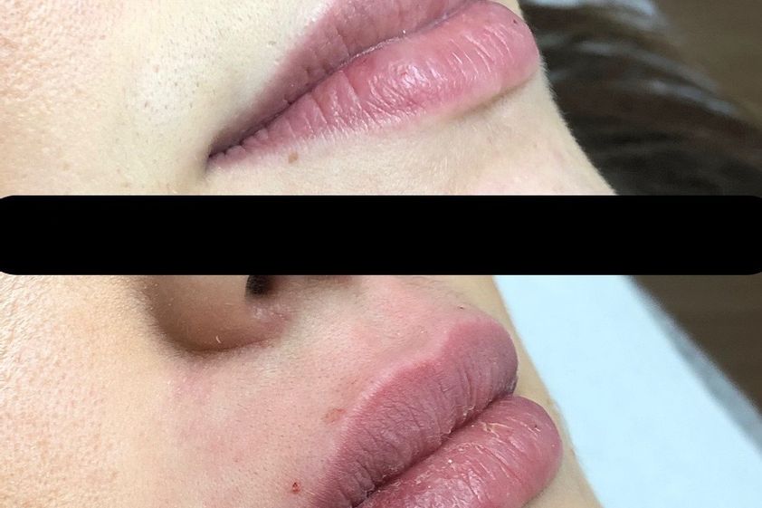 Augmentation des lèvres avant et après - 810295