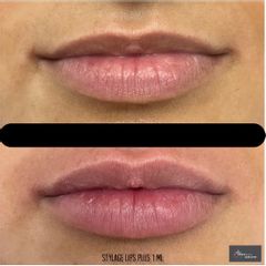 Augmentation des lèvres - Dr Bertrand Durantet