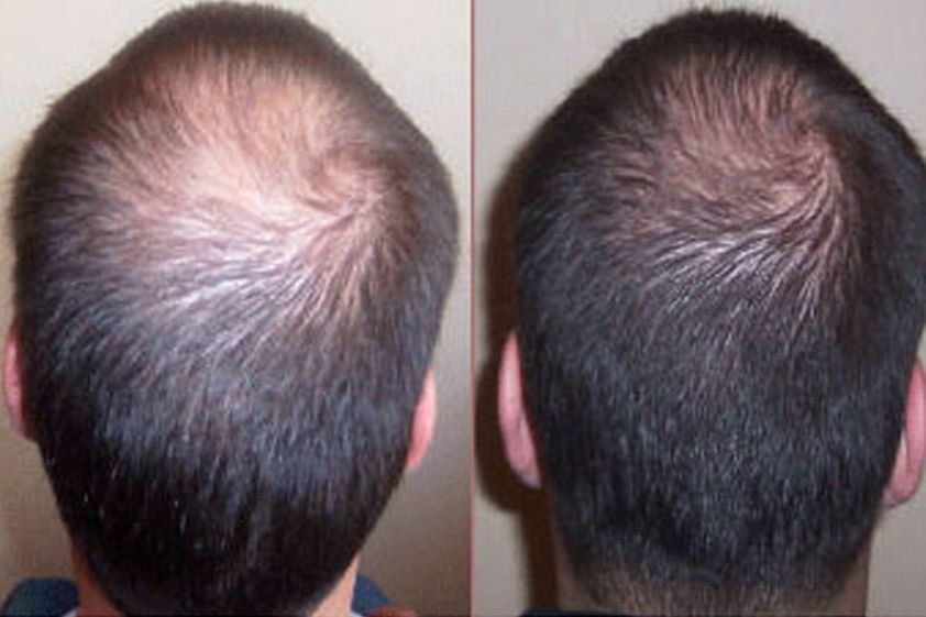 Greffe de cheveux avant et après - 468123