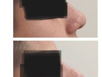 Rhinoplastie médicale avant et après - 866665