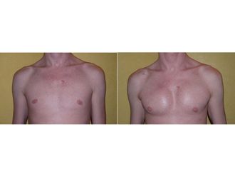 Implants pectoraux avant et après - 543634