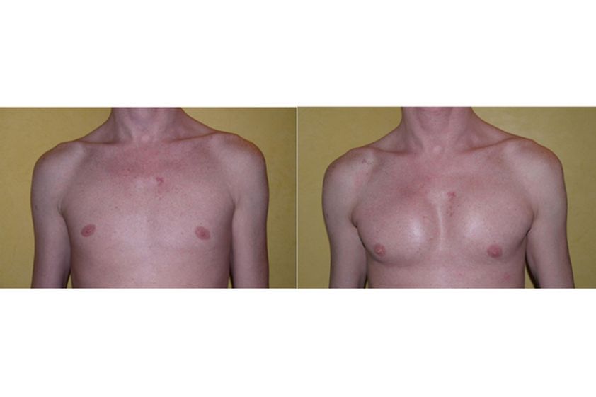 Implants pectoraux avant et après - 543634