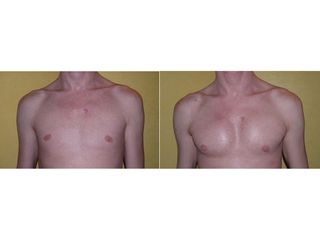Avant après Implants pectoraux