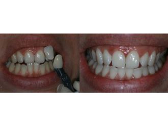 Blanchiment des dents - 548964
