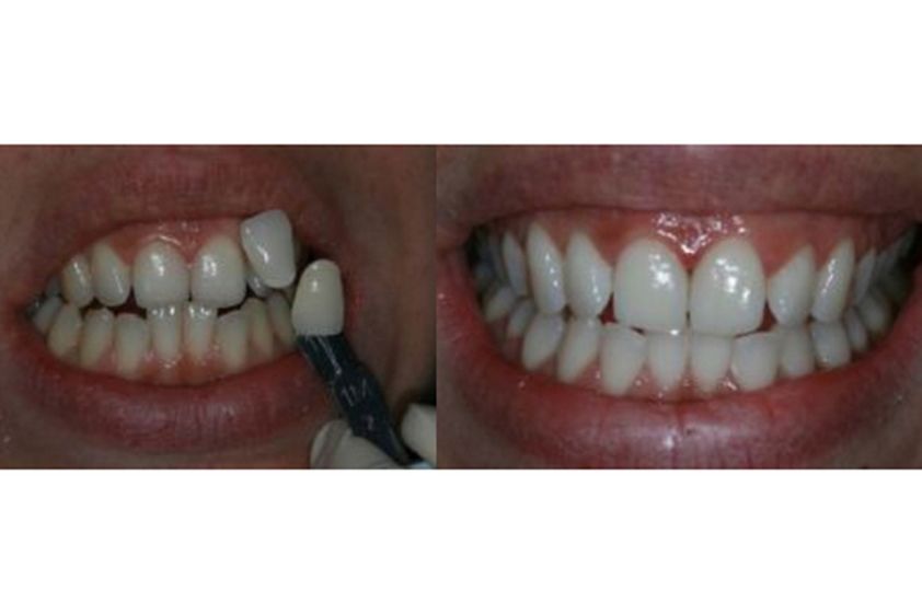 Blanchiment des dents avant et après - 548964