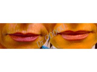 Augmentation des lèvres - Dr Laurent Oddou