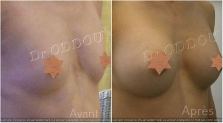 Augmentation mammaire - Dr Laurent Oddou