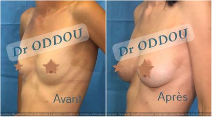 Augmentation mammaire - Dr Laurent Oddou