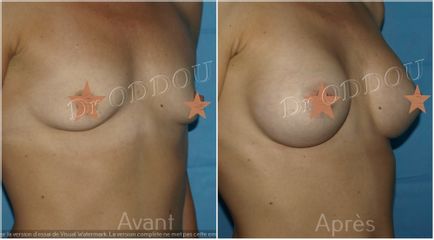 Augmentation mammaire - Dr Laurent Oddou