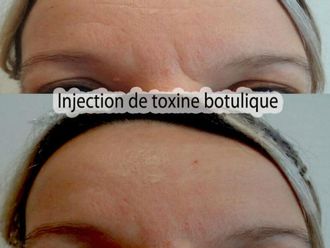 Botox-569848