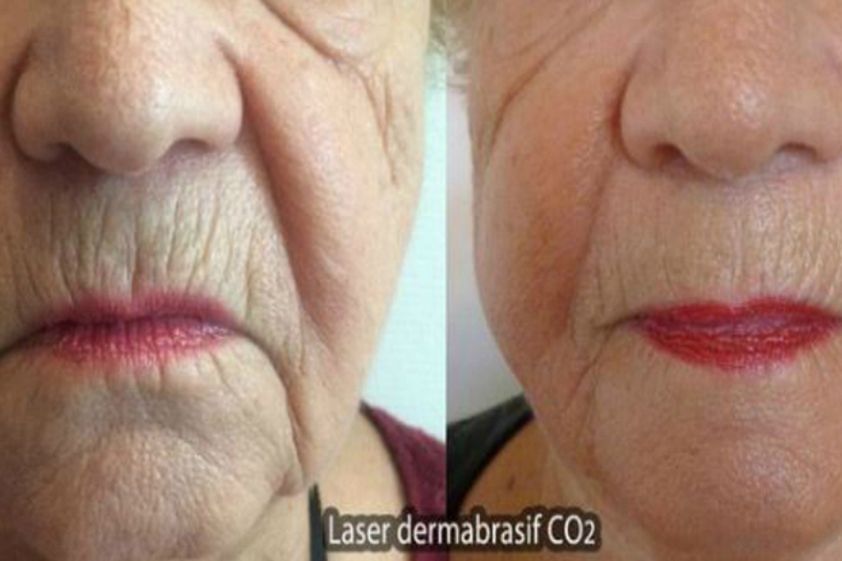 Laser dermatologique avant et après - 569849