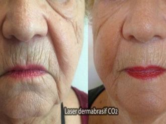 Laser dermatologique - 569849