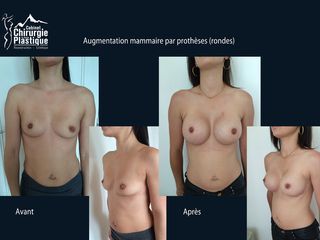 Avant après augmentation mammaire - Dr Antoine Grosdidier