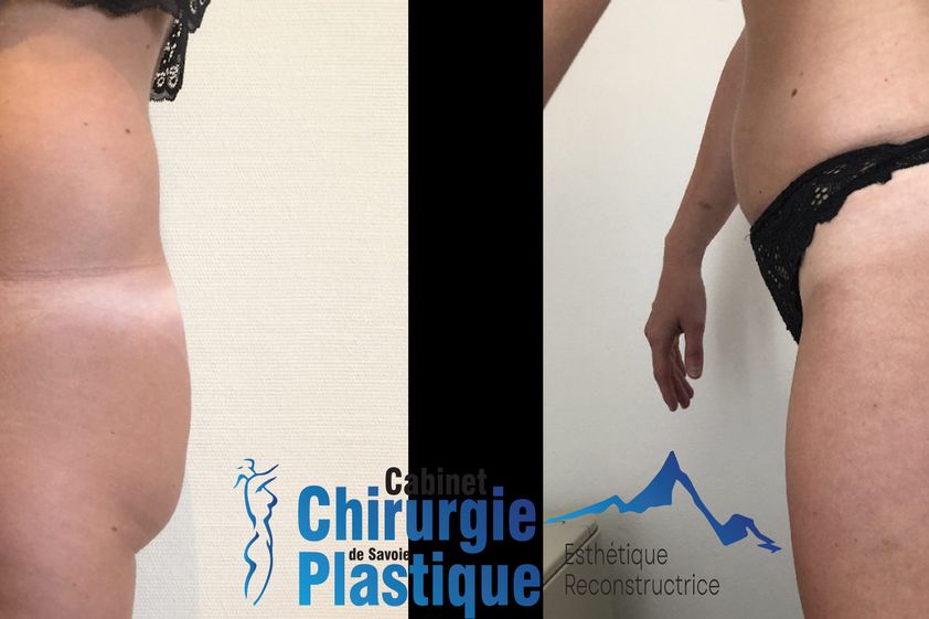Chirurgie des fesses avant et après - 845027