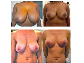 Avant après Chirurgie du sein