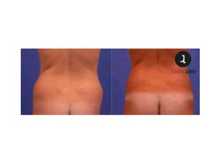 Avant après Lipoaspiration des hanches