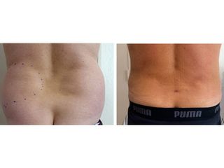 Avant après Liposuccion