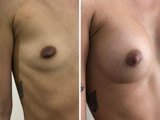 Augmentation mammaire - 630233