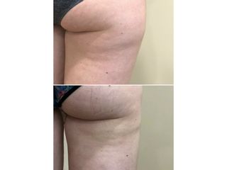 Avant après Lipoaspiration de la culotte de cheval (face externe de cuisse)