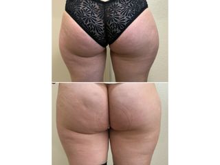 Avant après Lipoaspiration de la culotte de cheval (face externe de cuisse)