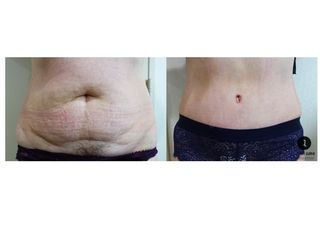 Avant après Abdominoplastie