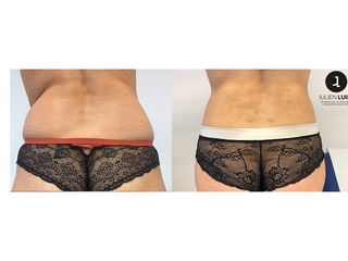 Avant après Liposuccion