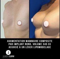 Augmentation mammaire - Dr Julien Luini