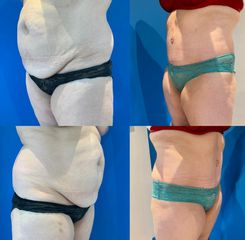 Abdominoplastie - Dr Julien Luini