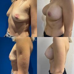 Augmentation mammaire par prothèses - Dr Julien Luini