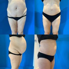 Plastie abdominale - Dr Julien Luini