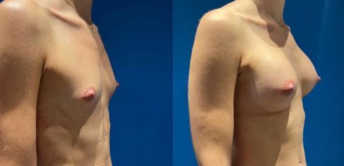 Augmentation mammaires par prothèses, voix d’abord sous mammaire - Dr Julien Luini