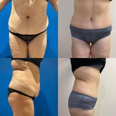 Abdominoplastie - Dr Julien Luini