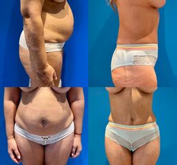 Liposuccion et mini abdominoplastie - Dr Julien Luini