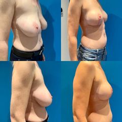 Lifting mammaire - Dr Julien Luini